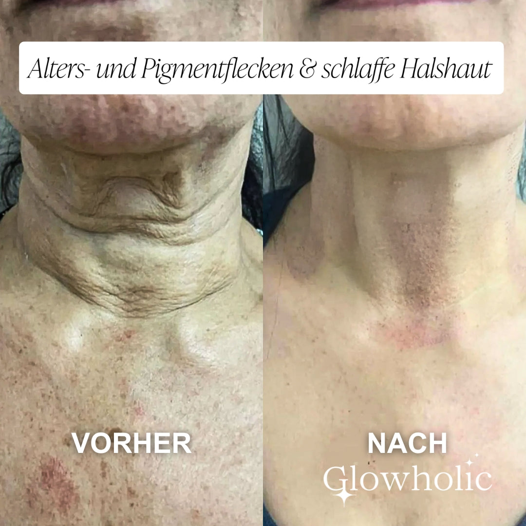Anti-Falten Starter Set - Glowholic Micro-Needling Infusion für zuhause