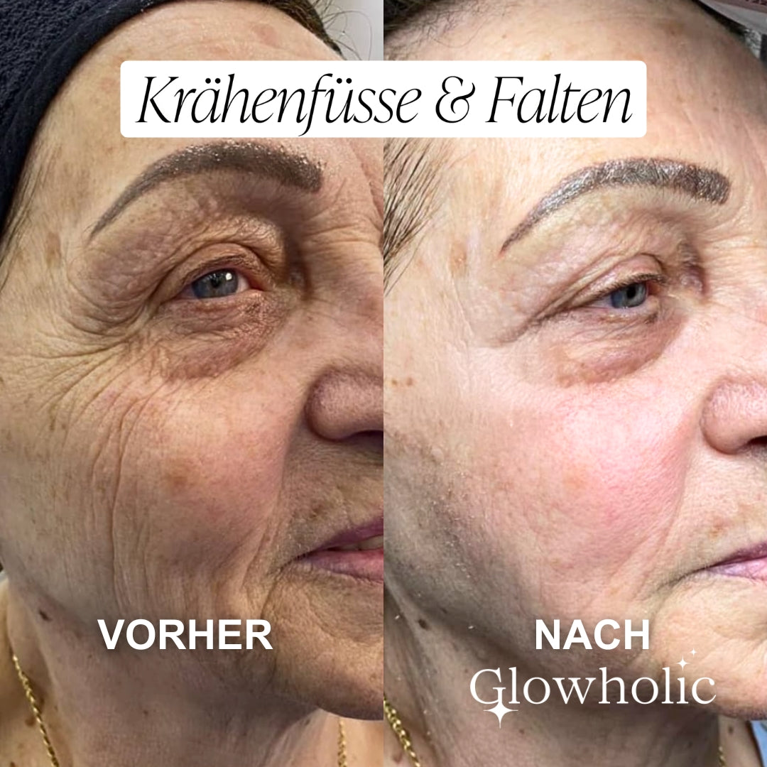 Sommer Anti-Falten Starter Set - Glowholic Micro-Needling-Infusion