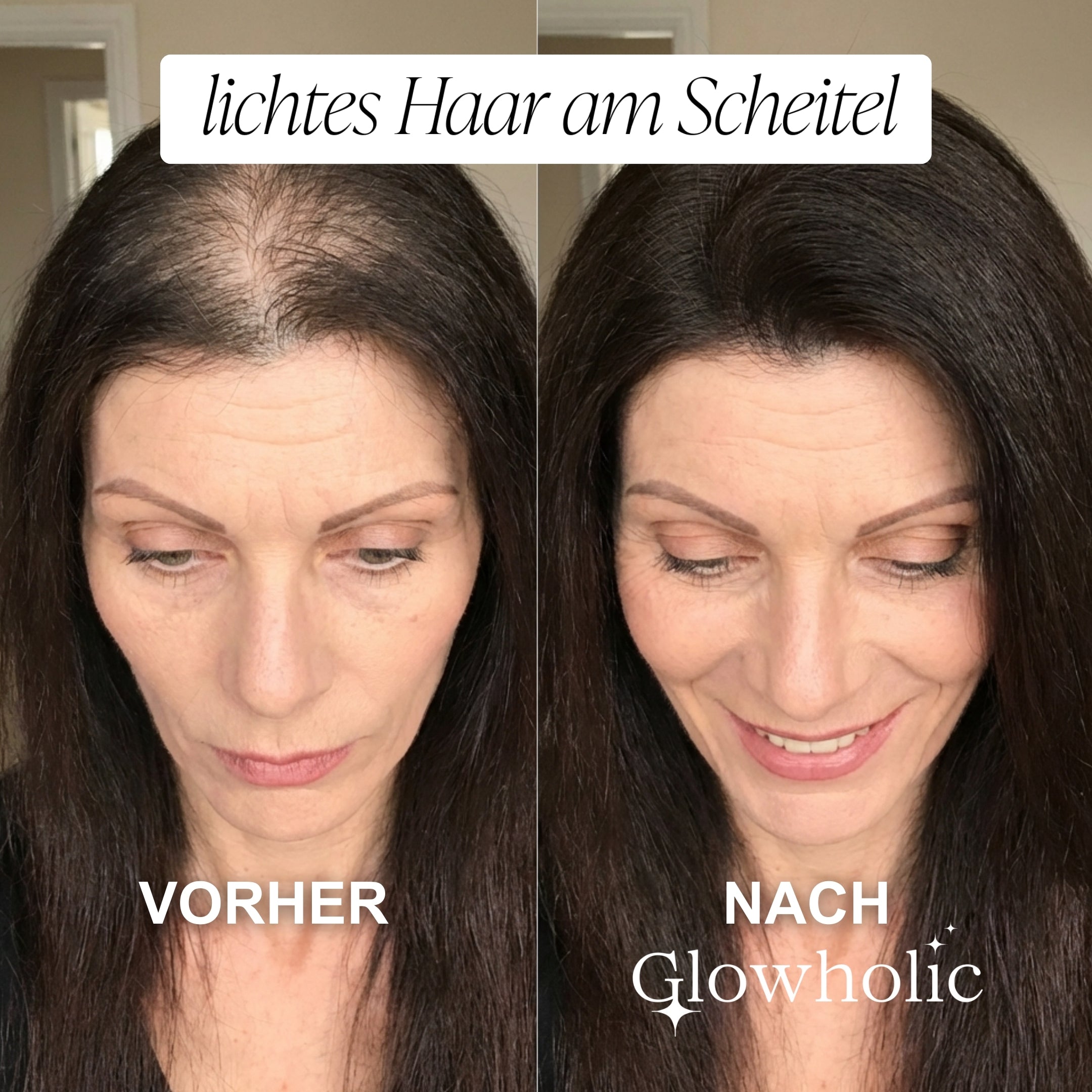 Glowholic - Anti-Haarausfall Starter Set - Micro-Needling Infusion für zuhause