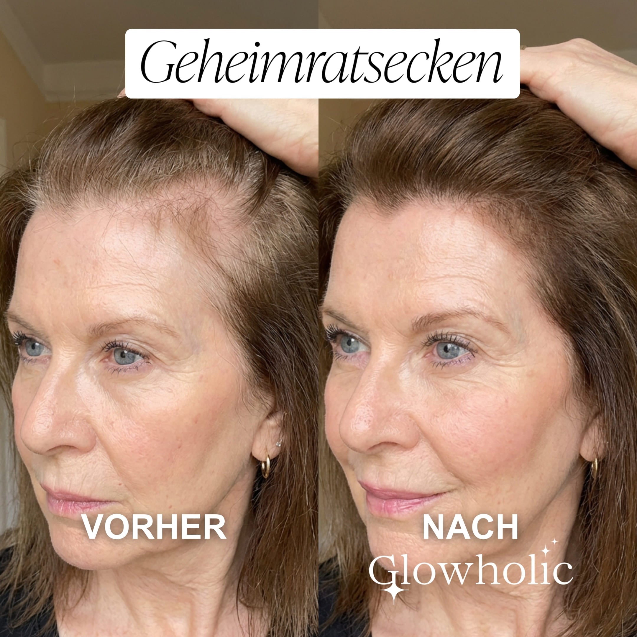 Glowholic - Anti-Haarausfall Starter Set - Micro-Needling Infusion für zuhause