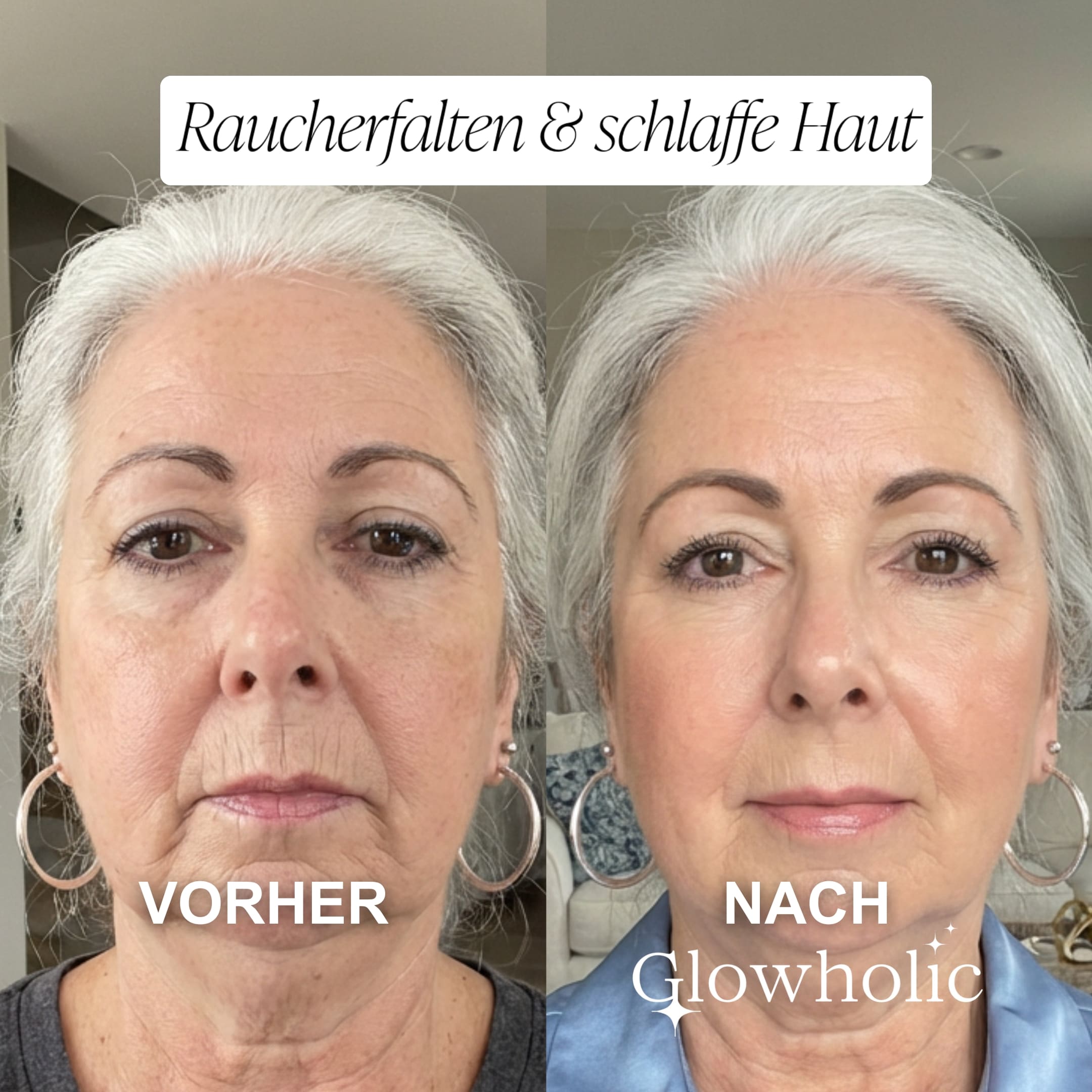 Glowholic Anti-Falten Micro-Needling Infusion Patches