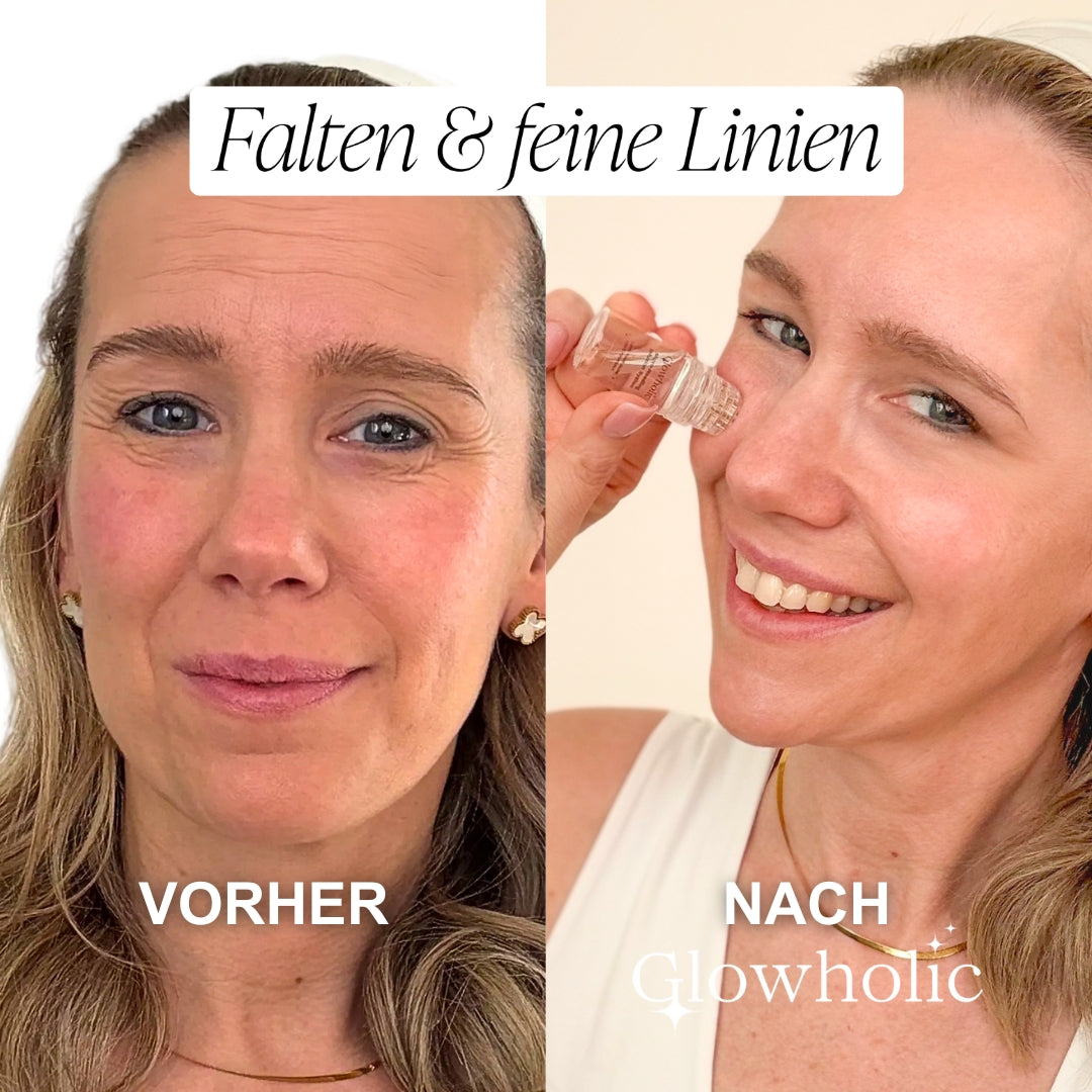 Limitiertes Black Friday Special: Glow & Recovery Set - Glowholic Micro-Needling Infusion für zuhause