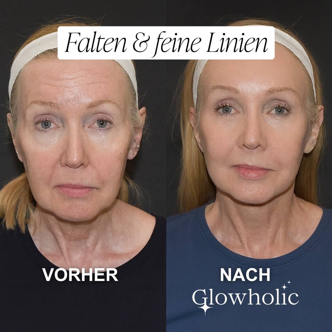 Glowholic Anti-Falten Micro-Needling Infusion Patches