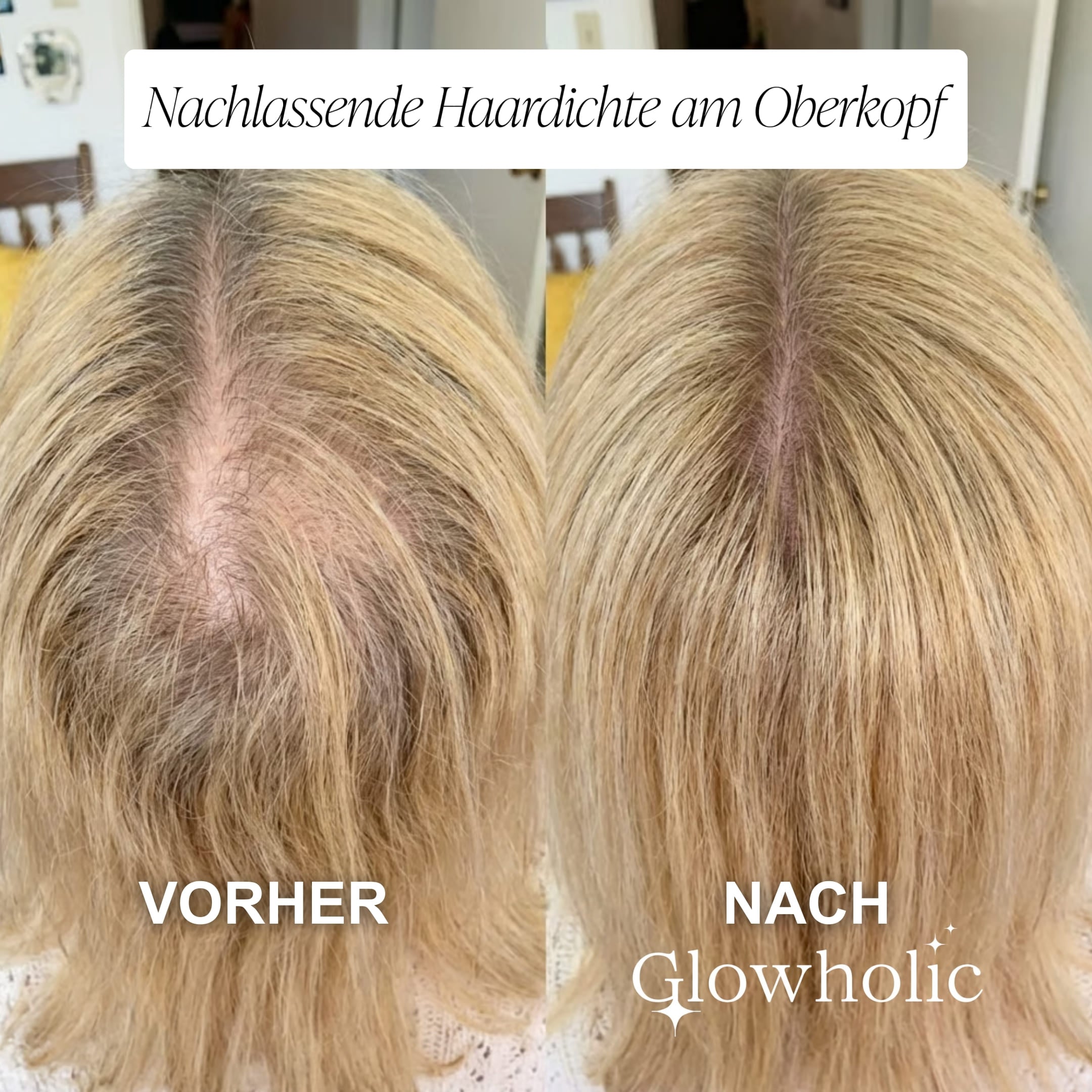 Glowholic - Anti-Haarausfall Starter Set - Micro-Needling Infusion für zuhause