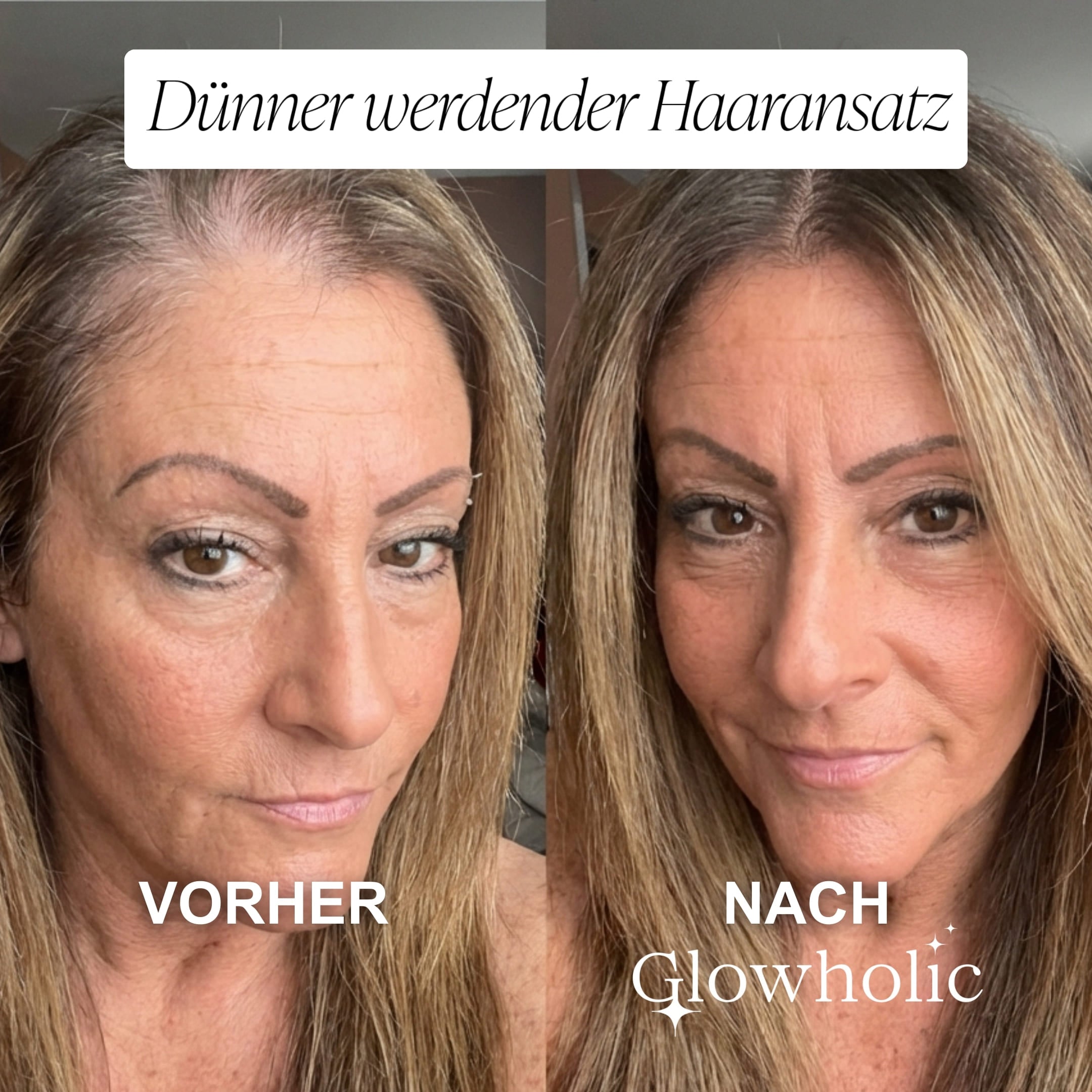 Glowholic - Anti-Haarausfall Starter Set - Micro-Needling Infusion für zuhause
