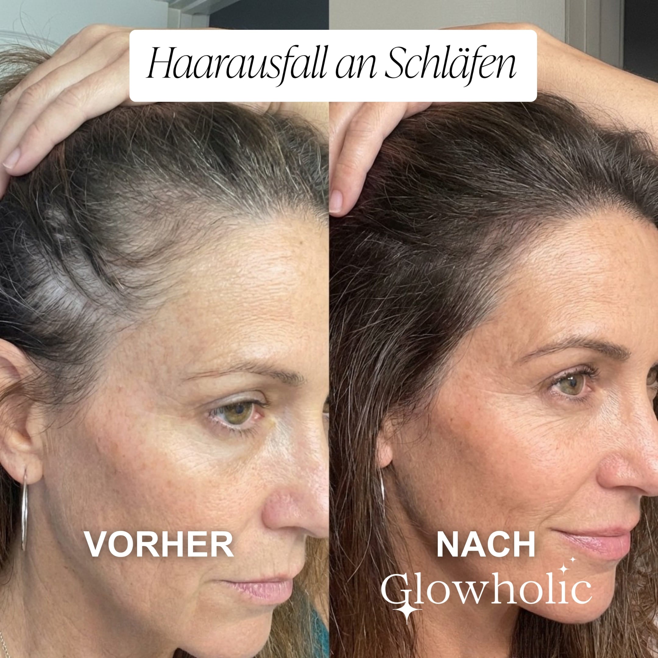 Glowholic - Anti-Haarausfall Starter Set - Micro-Needling Infusion für zuhause