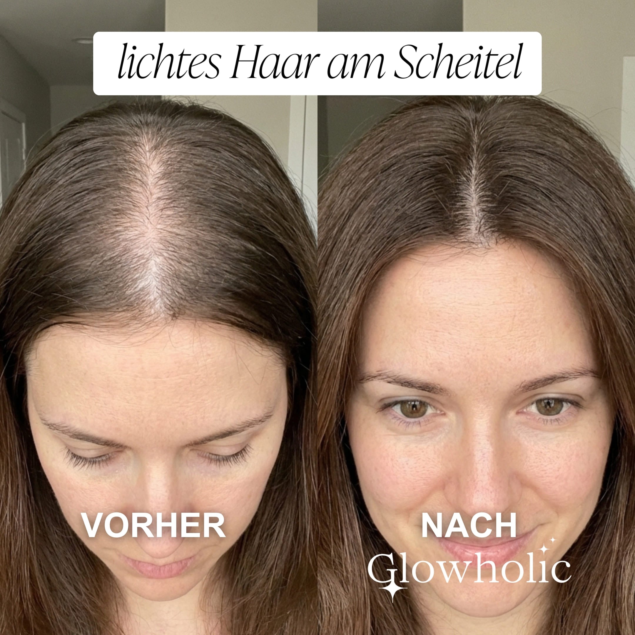 Glowholic - Anti-Haarausfall Starter Set - Micro-Needling Infusion für zuhause